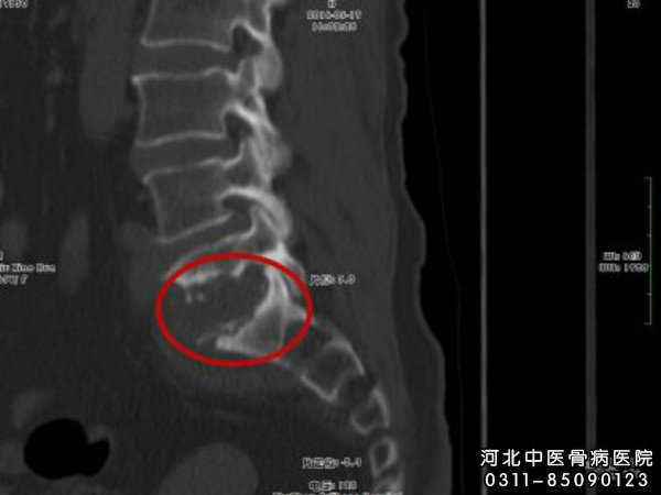 腰椎结核应手术治疗吗_河北中医骨病医院