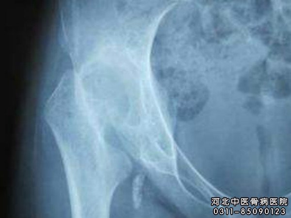 骨结核
