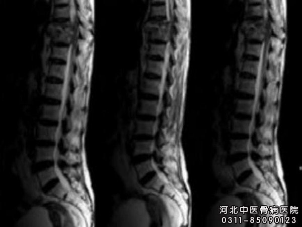 骨结核