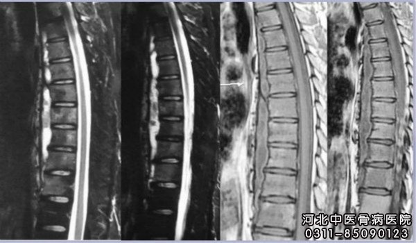 骨结核