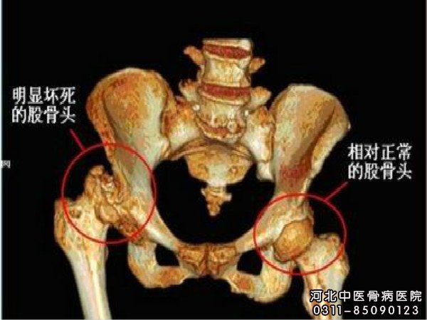 股骨头坏死