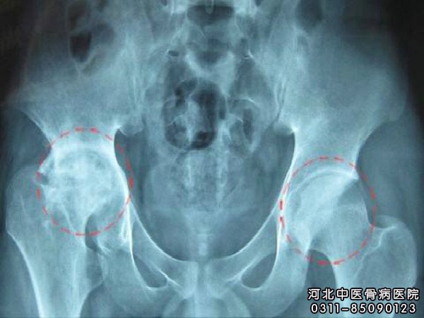 股骨头坏死