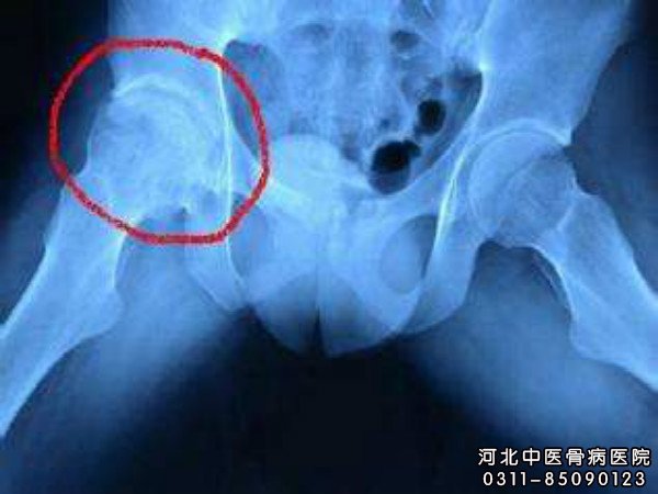 股骨头坏死