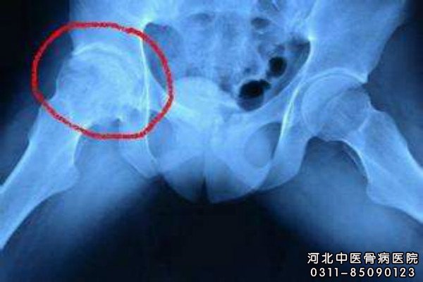 股骨头坏死的部位