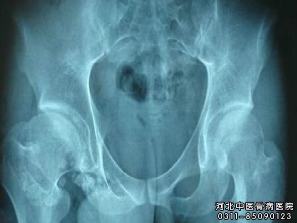 股骨头坏死病理部位的X片