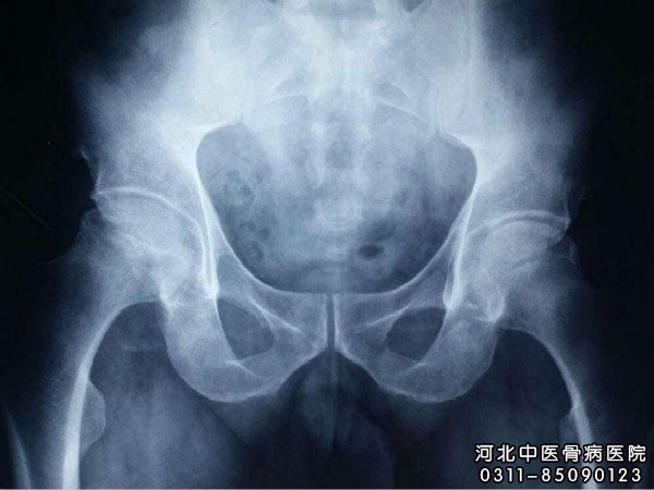 股骨头坏死