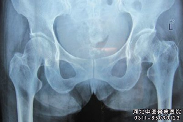 股骨头坏死的X片