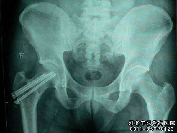 股骨头的右侧部位出现坏死