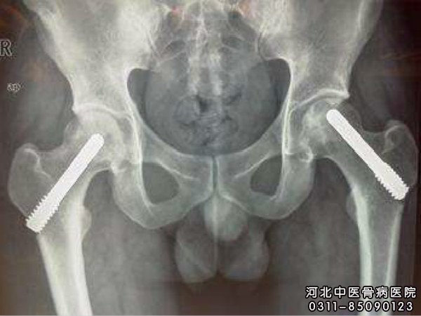 双侧股骨头均有坏死部位
