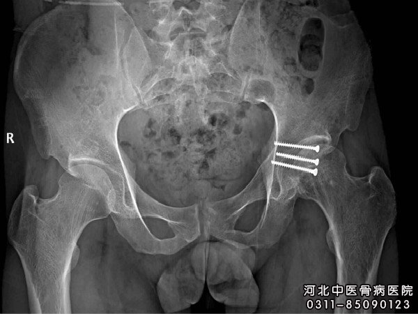 股骨头坏死的X片