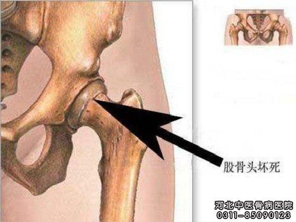 箭头所示方向为股骨头坏死的部位