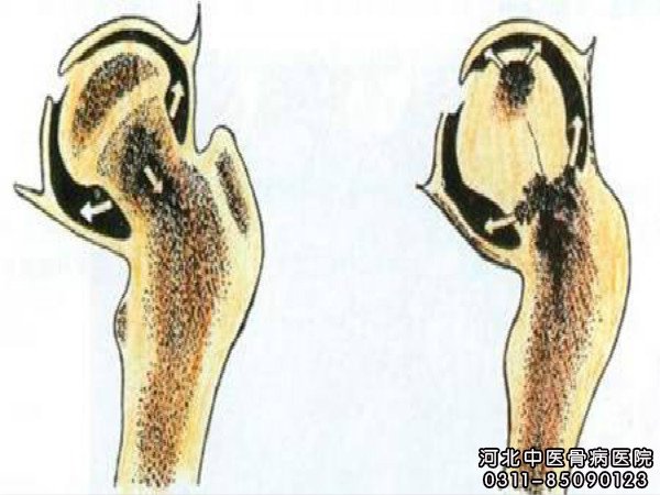 股骨头坏死骨头的部位