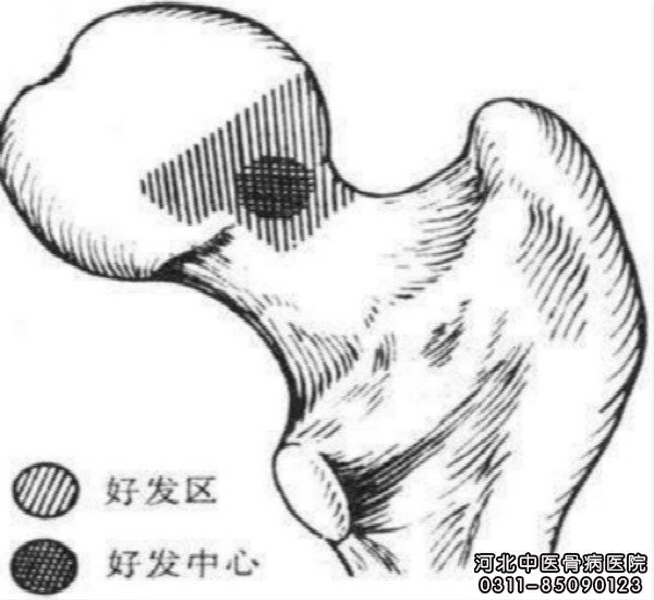 股骨头坏死的好发区和好发部位