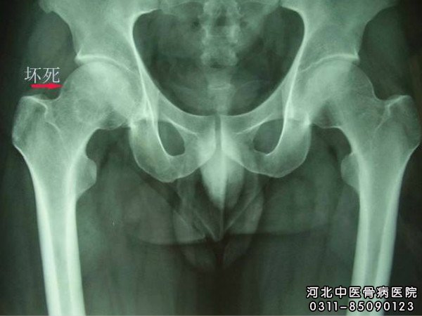 股骨头坏死患者的X片