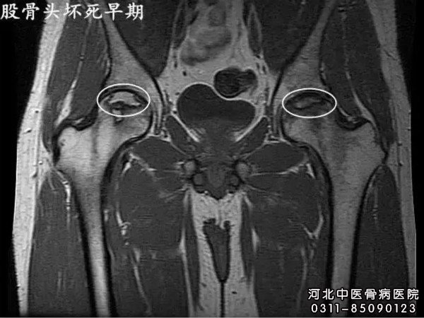 股骨头坏死早期症状变化