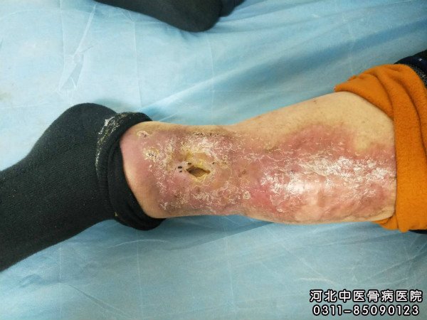 我院骨髓炎患者逐渐恢复的伤口部位