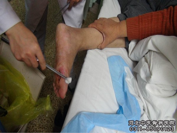 我院足部骨髓炎患者伤口处