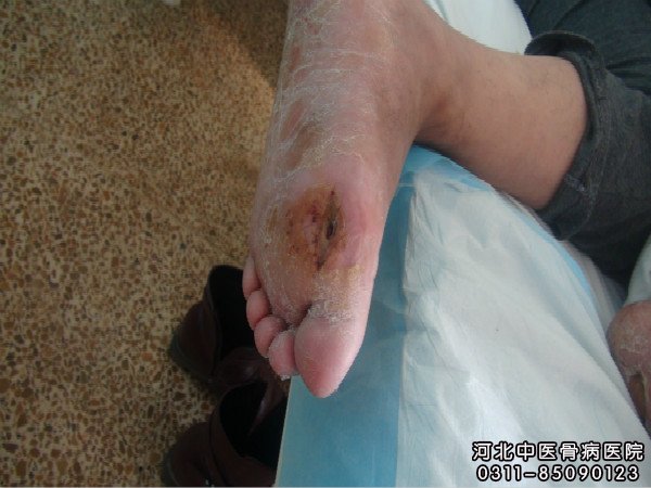骨髓炎足部患者伤口在逐渐好转