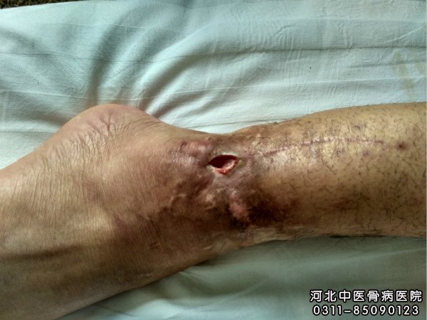 骨髓炎出现一个小口不愈合