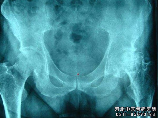 股骨头坏死X片