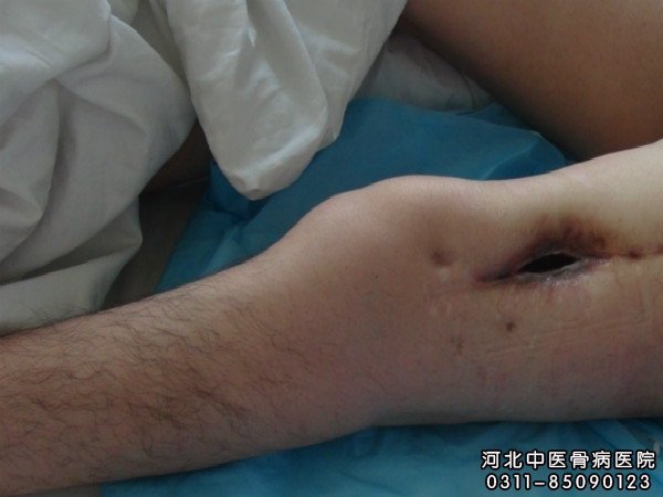 骨髓炎伤口不愈合