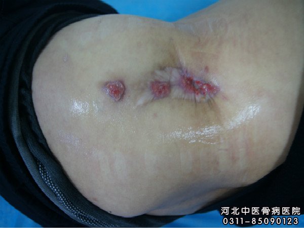 骨髓炎伤口不愈合