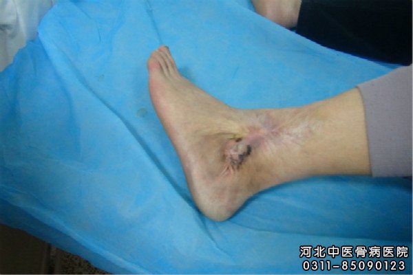 我院骨髓炎患者足部伤口基本愈合