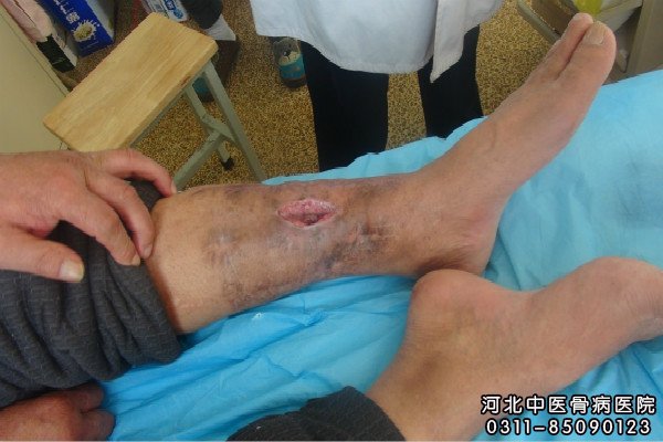 我院骨髓炎住院患者