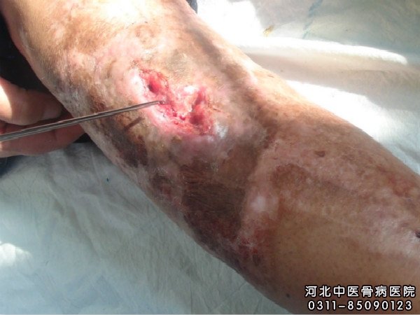 我院骨髓炎患者的伤口部位