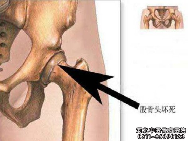 股骨头坏死的示意图