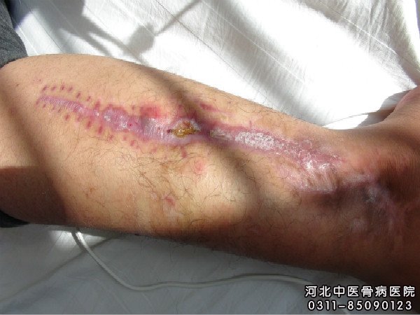 骨髓炎患者伤口部位流脓