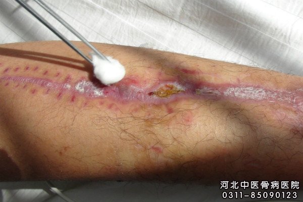 我院骨髓炎患者的伤口部位正在逐渐愈合