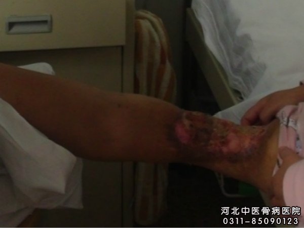 我院骨髓炎住院患者的伤口部位