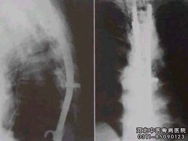 脊椎骨骨髓炎