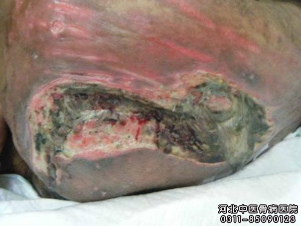 褥疮患者的伤口部位