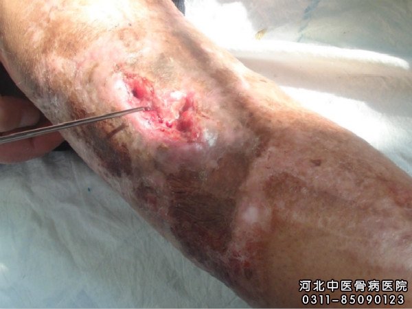 腿部骨髓炎患者的伤口部位不愈合