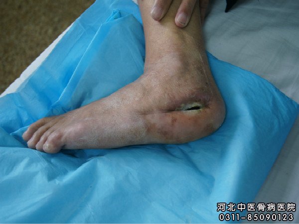 骨髓炎伤口部位久不愈合