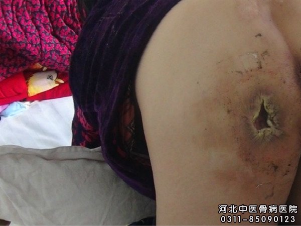 我院褥疮住院患者的患处