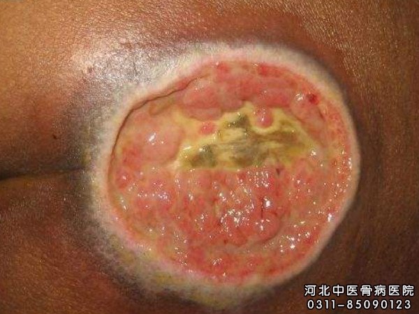 褥疮患者的患处