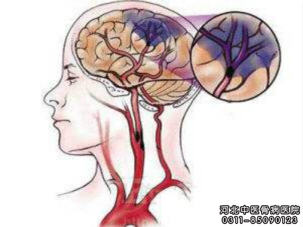 脑卒中示意图