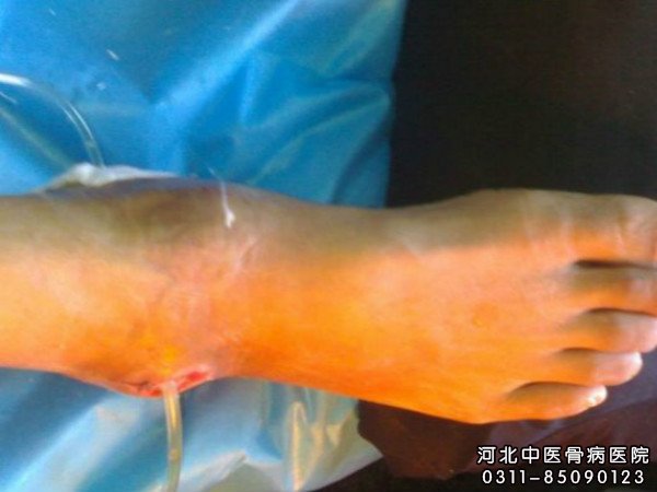 伤口有窦道