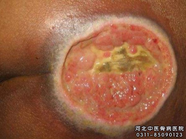 褥疮患者的伤口部位