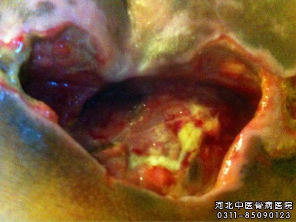 褥疮患处部位破溃流脓