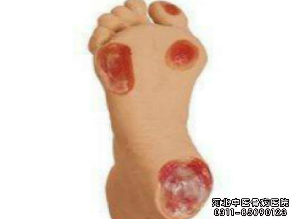 褥疮患病部位
