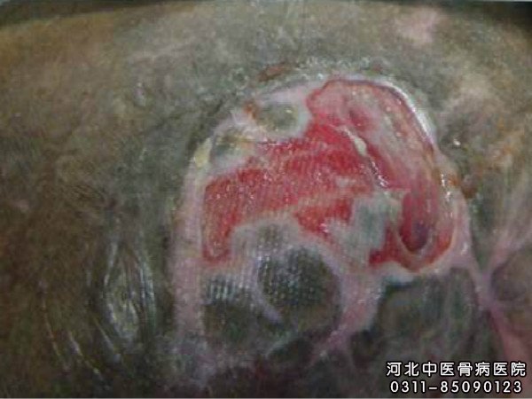 褥疮的发病部位