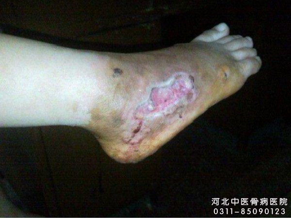 褥疮患者要及时进行治疗避免病情加重