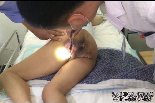 我院褥疮患者的治疗