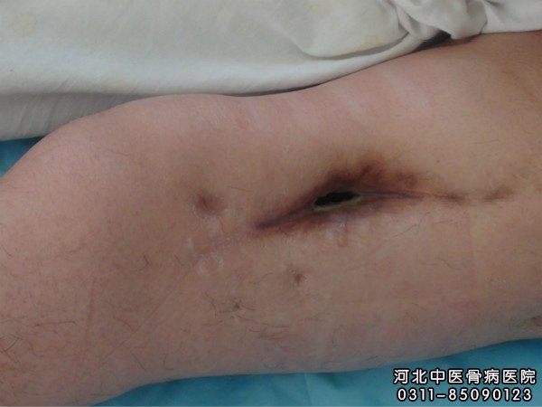 我院骨髓炎住院患者的病情