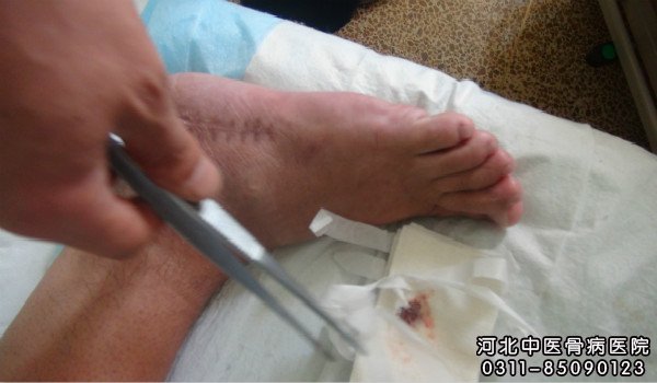 我院骨髓炎住院患者在进行换药