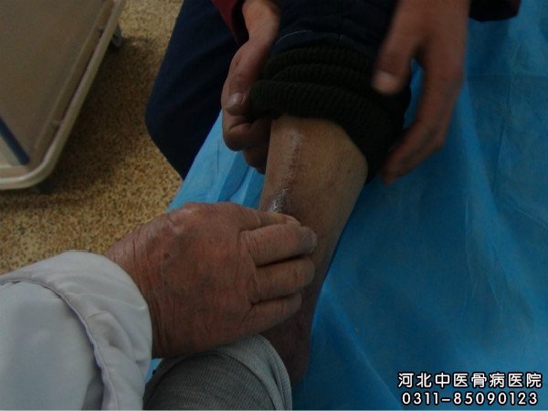 我院骨髓炎住院患者的伤口